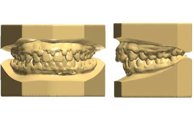 analilsi modelli-3d-ortodonzia